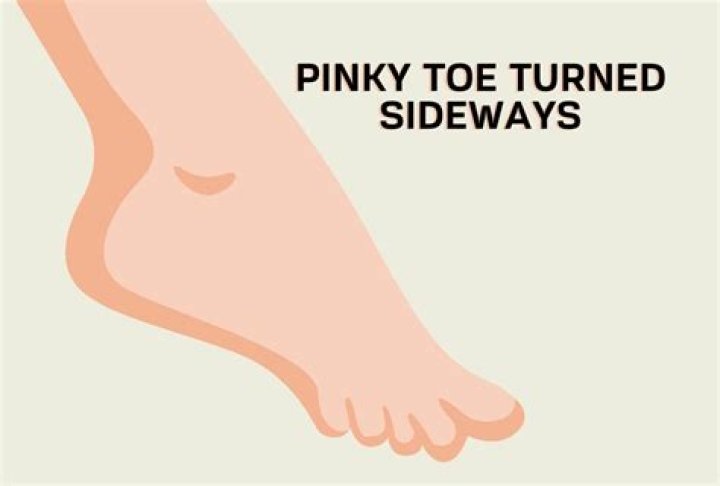 Embracing The Quirk: The Sideways Pinky Toe Phenomenon