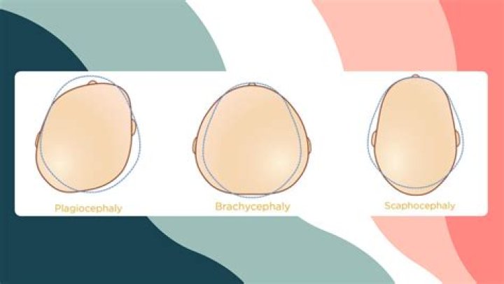 Is Plagiocephaly A Celebrity Trend? Here's The Scoop