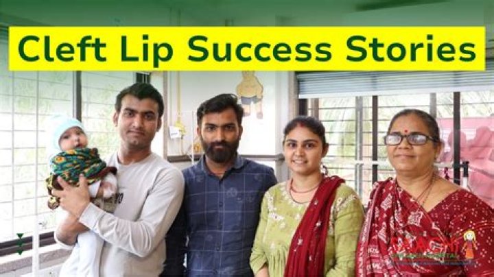 The A-List Stars With Cleft Lip: Inspiring Success Stories